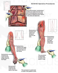 Multiple Escharotomy Incisions to the Chest, Leg and Arm