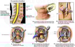 Cervical Injury with Surgical Repair