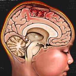 Depressed Skull Fracture in Child