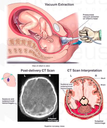 Vacuum Extraction Delivery with Subgaleal, Subdural and Subarachnoid Hemorrhages