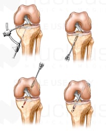 ACL Reconstruction Surgery