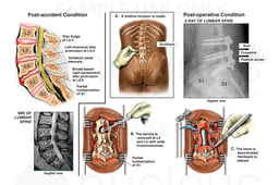 Lumbar Spine Injury with Surgical Decompression and Fusion