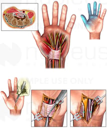 Carpal Tunnel Syndrome and Surgical Release: Left Hand