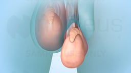 Sperm Retrieval Procedures for Conception