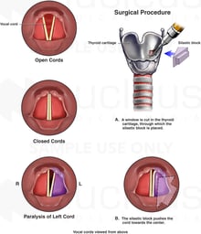 Unilateral Vocal Cord Paralysis with Surgical Repair