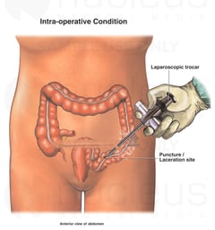 Bowel Puncture / Laceration During Laparoscopic Surgery