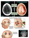 Surgical Drainage of Subdural Hematoma