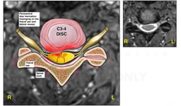 C3-4 Disc Herniation