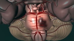 Pontine and Midbrain Stroke
