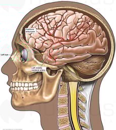 Location of Left Middle Cerebral Artery Aneurysm