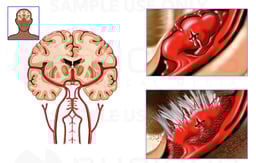 Rupture of Middle Cerebral Artery Aneurysm