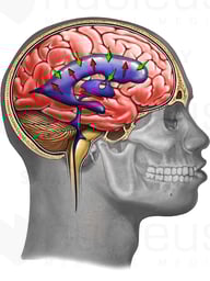 Abnormal CSF circulation