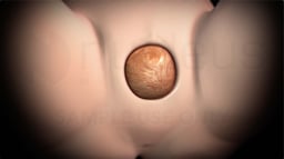 What is an Episiotomy?