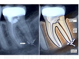 Root Canal Overfill