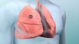 Managing Lung Cancer