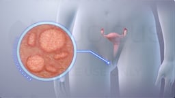 Genital Herpes in Women