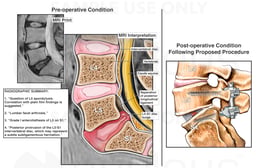 L5-S1 Lumbar Spine Injury with Proposed Future Surgical Fusion