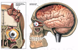 Post-accident Skull and Brain Injuries