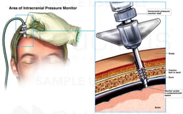 Placement of Intracranial Pressure Monitor