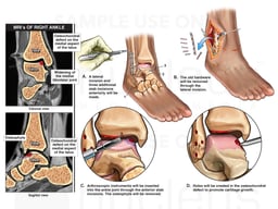 Right Ankle Injury with Proposed Future Surgery