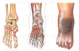 Crush Injuries of the Foot and Ankle