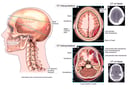 Lateral Male Skull with Post-accident Injuries of the Head and Neck