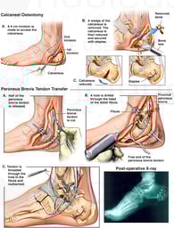 Additional Left Ankle and Foot Surgeries