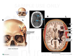 Taumatic Head Injuries