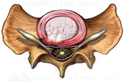 Spinal Cord Compression - Herniated L5-S1 Disc Compressing Sacral Nerve Roots