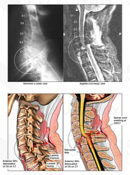 50% Dislocation of C6/C7 and Spinal Cord Injury