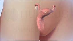 How Long Can an IUD Stay In?