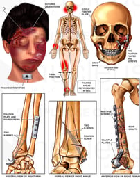 Surgical Repairs to the Skull, Forearm, Thigh and Ankle