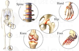 Osteoarthritic Joints