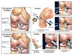 Right Knee Injuries with Surgical Procedures