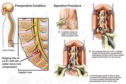 Lumbar Disc Herniation with Surgical Repairs