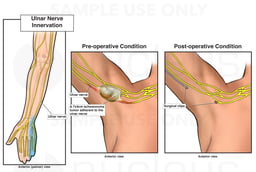 Right Axillary Tumor Resection with Ulnar Nerve Damage