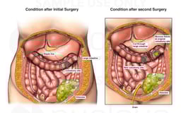 Initial Surgical Procedures