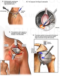 Right Shoulder Arthroscopic and Open Surgeries