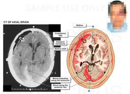 Fatal Intracranial hemorrhage