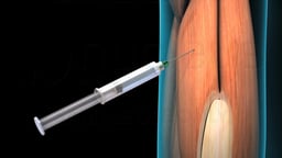 Intramuscular injection in the Upper Arm