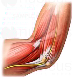 Ulnar Nerve Entrapment