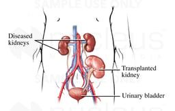 Kidney Transplant