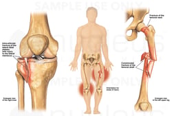 Tibial Plateau and Femur Fractures