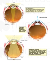 Use of Proparacaine with Resulting Corneal Damage