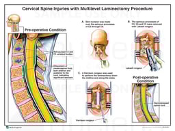 Cervical Spine Injuries with Multilevel Laminectomy Procedure