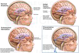Progression of Hydrocephalus
