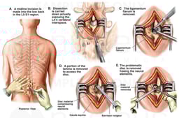 L4-5 Microdiscectomy Procedure