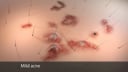 Mild Acne of the Skin