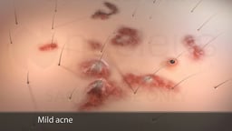 Mild Acne of the Skin