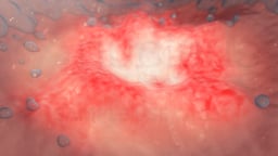 Surgical Treatment for Peptic Ulcers